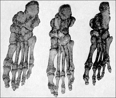 Сравнение скелета стопы японца, европейца и австралийца (по Герману Клаачу)